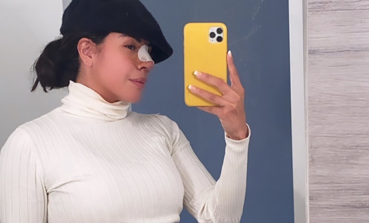 ¡COMO NUEVA! Así fue el resultado de la rinoplastia de Kerly Ruiz